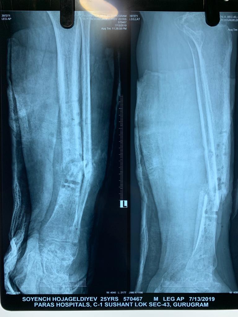 limb-lengthening-surgery