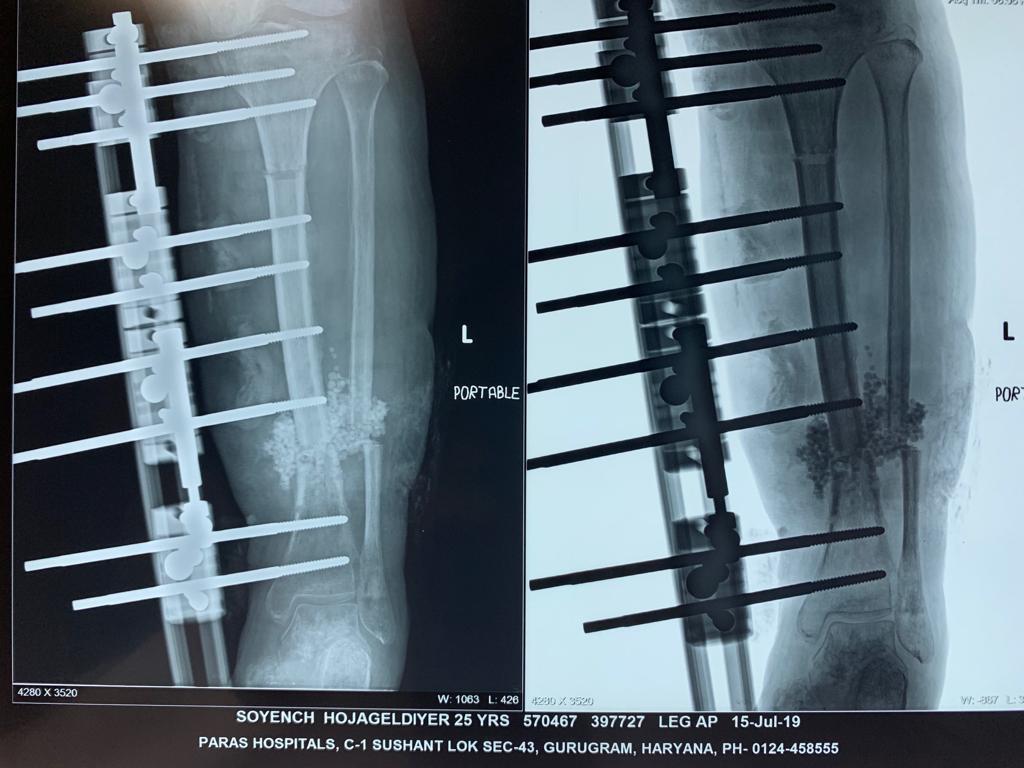 limb-lengthening-surgery