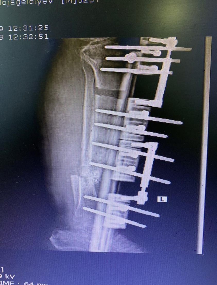 limb-lengthening-surgery