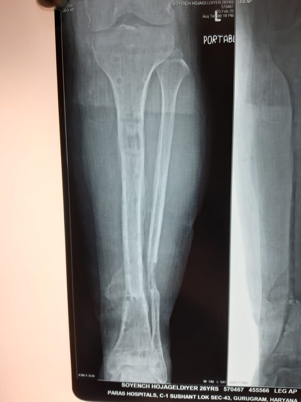 limb-lengthening-surgery